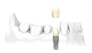Perfect Smile Cemented Implant Supported Crown
